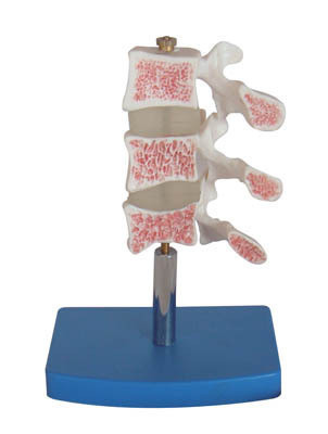 人体脊椎病变模型 骨质疏松病变腰椎椎间盘 骨