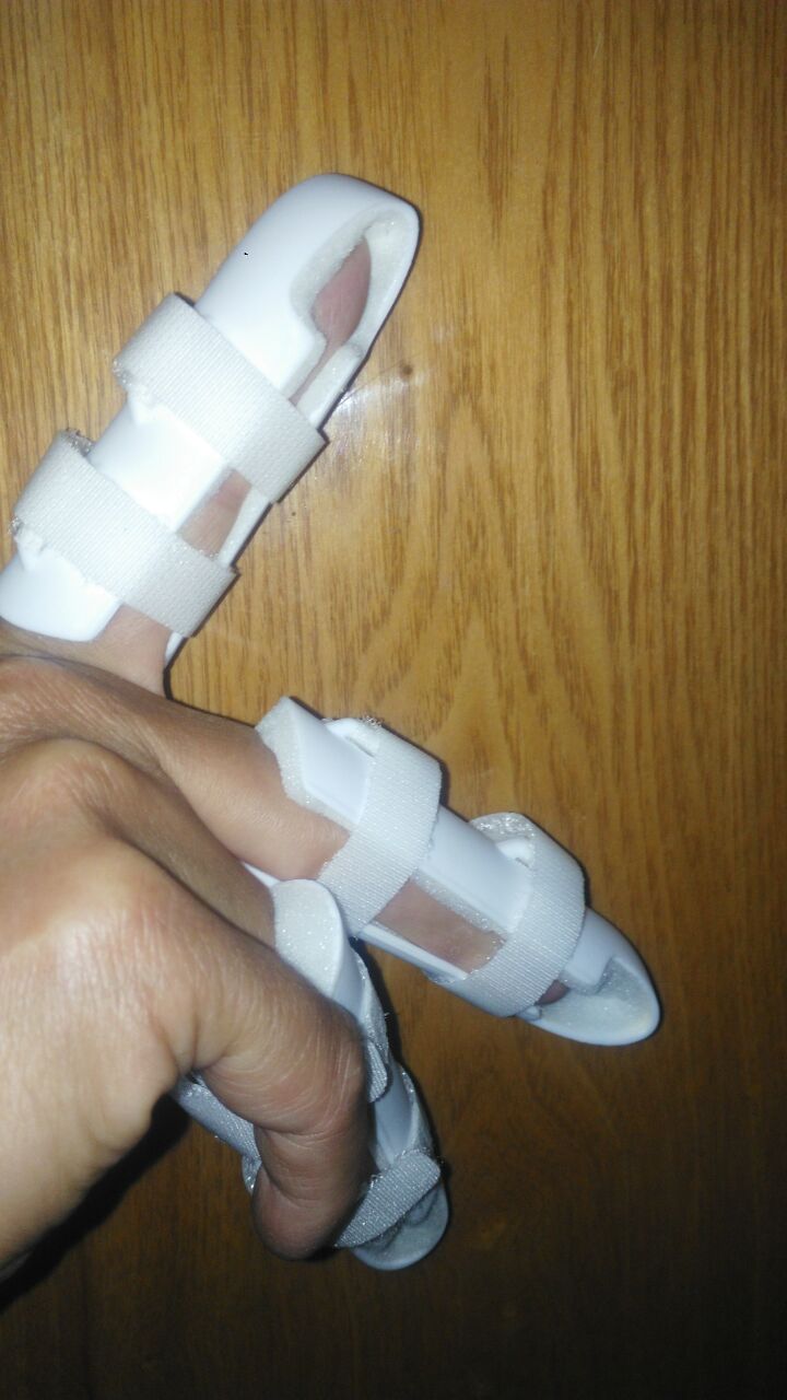 护指锤状指矫正 手指关节骨折脱位肌腱断裂固定康复护托夹板