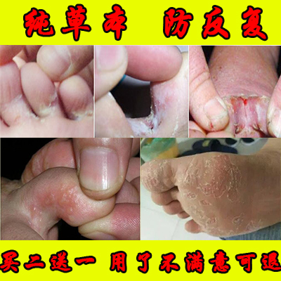 植物云南草本脚气喷剂脚气去跟止痒神器脱皮有脚气用什么药云南|ruв категории локализация жизни услуг, службы здравоохранения, Ванны для ног/баня/массаж - от Buy2taobao.com для оказания профессиональной услуги покупки агента Taobao