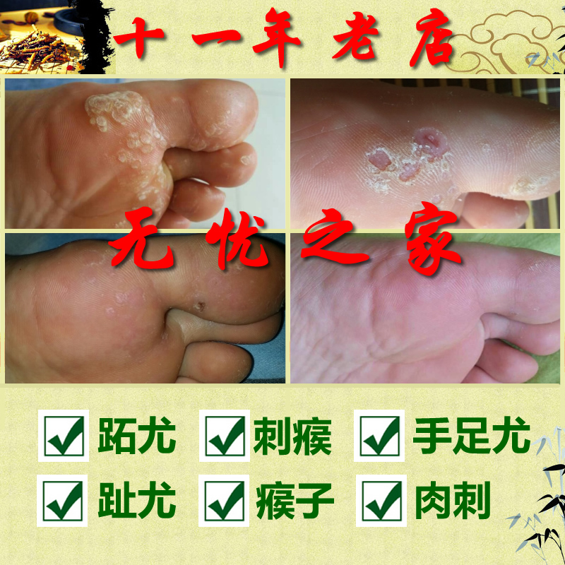 無憂之家 祛除瘊靈跖趾疣尤淨康手足腳尤肉刺瘊猴子雞眼 小樣在類目 寵物/寵物食品及用品, 貓/狗醫療用品(新), 其他中 - 來自Buy2taobao.com提供專業的淘寶代購服務