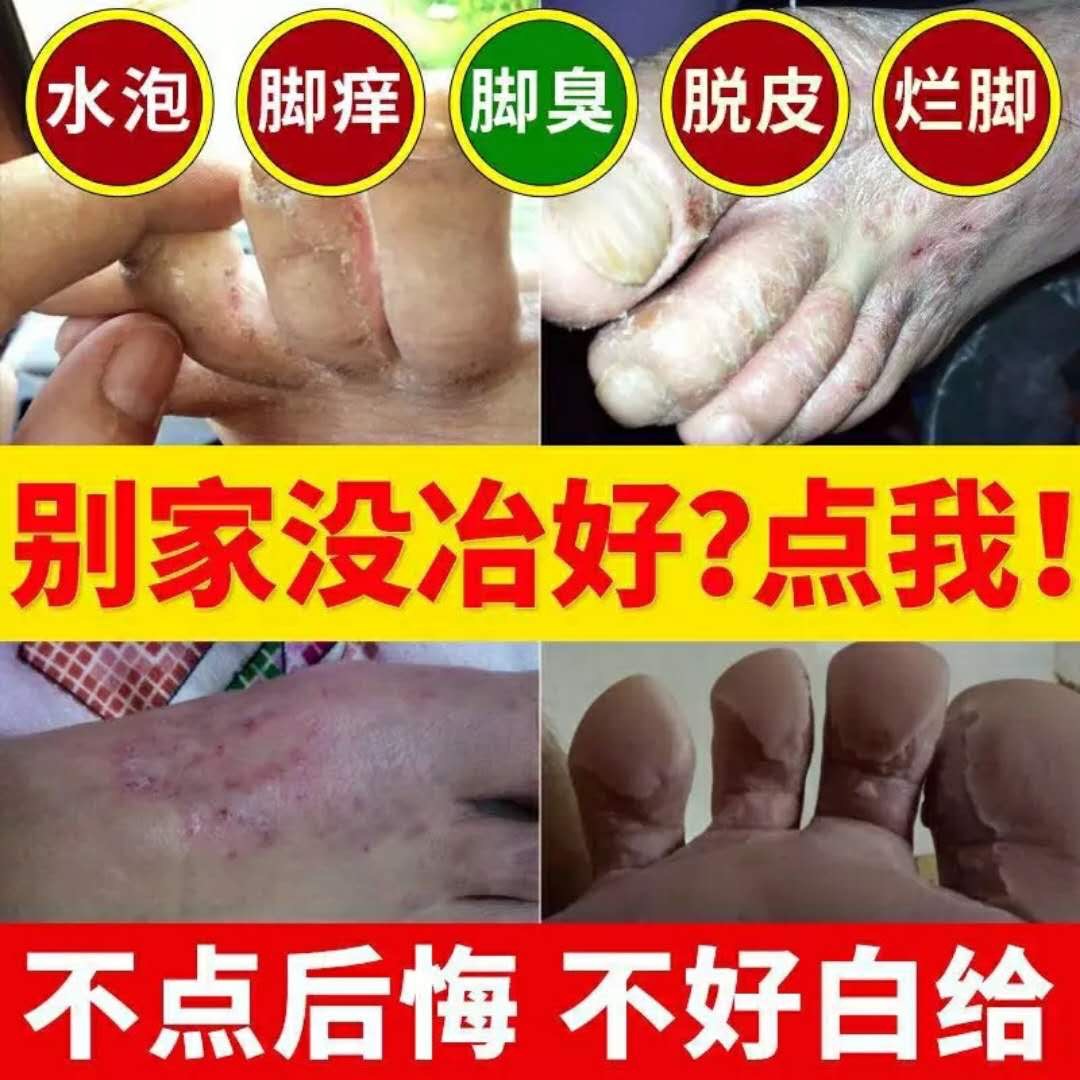 去脚气藥真菌感染止痒去脚气脱皮根烂脚臭脚丫水泡型正品|msdalam kategori Penyetempatan perkhidmatan kehidupan, Perkhidmatan kesihatan, kaki/Bath/urut - dari Buy2taobao.com untuk memberikan perkhidmatan ejen Taobao profesional membeli