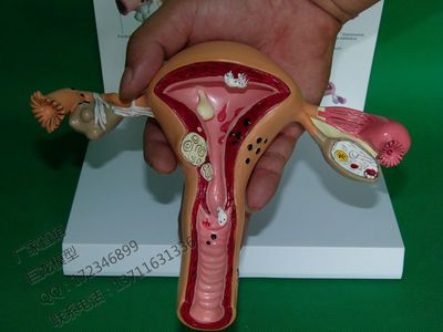 子宫,卵巢病理病变模型 生殖科 医药礼品模型 女性子宫阴道模型