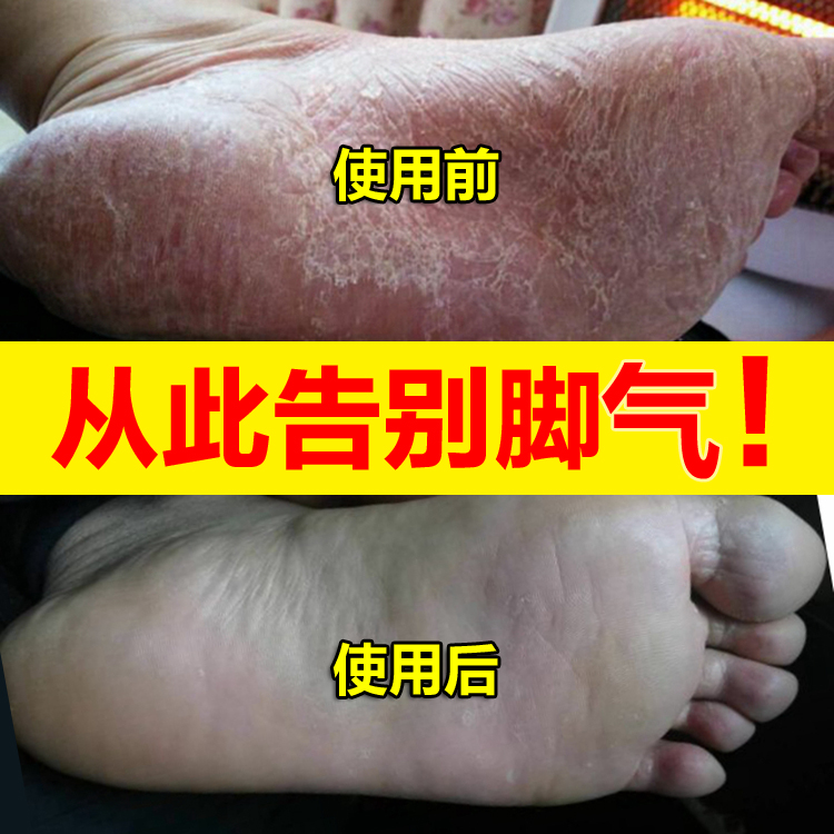 專用治療腳氣去根除止癢手腳蘚真菌感染脫皮水泡型腳臭腳藥膏神器在類目 本地化生活服務, 健康服務, 足浴/洗浴/按摩中 - 來自Buy2taobao.com提供專業的淘寶代購服務