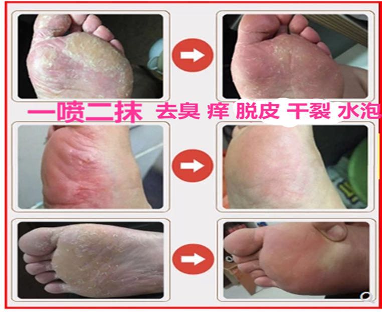 脚气克星除汗脚脚痒脱皮糜烂脚臭鞋袜泡脚包真菌喷去根剂神器药膏在类目 本地化生活服务, 健康服务, 足浴/洗浴/按摩中 - 来自Buy2taobao.com提供专业的淘宝代购服务