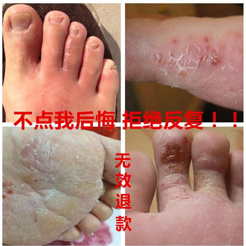 外用治疗脚气膏去根除止痒脱皮水泡型喷剂脚臭脚汗克星药膏王神器在类目 本地化生活服务, 健康服务, 足浴/洗浴/按摩中 - 来自Buy2taobao.com提供专业的淘宝代购服务