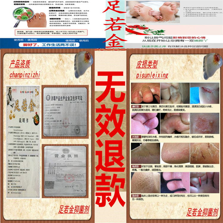 Peeling off skin Available Tinea manus Fungal infections Peeling off skin Blister relieve itching Dermatosis ointment Hand and Foot Tinea Goose Palm Windin the Localization of life services , Health Services , Foot/Bath/Massage category - from Buy2taobao.com to provide professional Taobao agent buy service