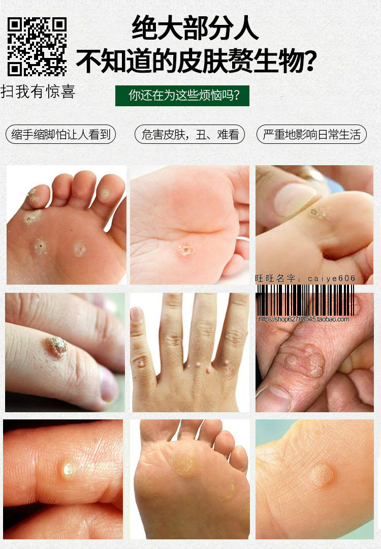 克疣液特效去除跖疣扁平瘊子手足肉刺皮赘脖子丝状疣寻常疣去疣灵在类目 个性定制/设计服务/DIY, 包装用品定制, 其它定做类中 - 来自Buy2taobao.com提供专业的淘宝代购服务