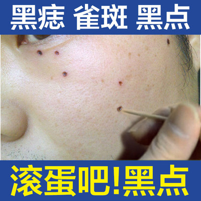 美容金水去黑痣膏点痣药水无痕正品袪痣灵痦子