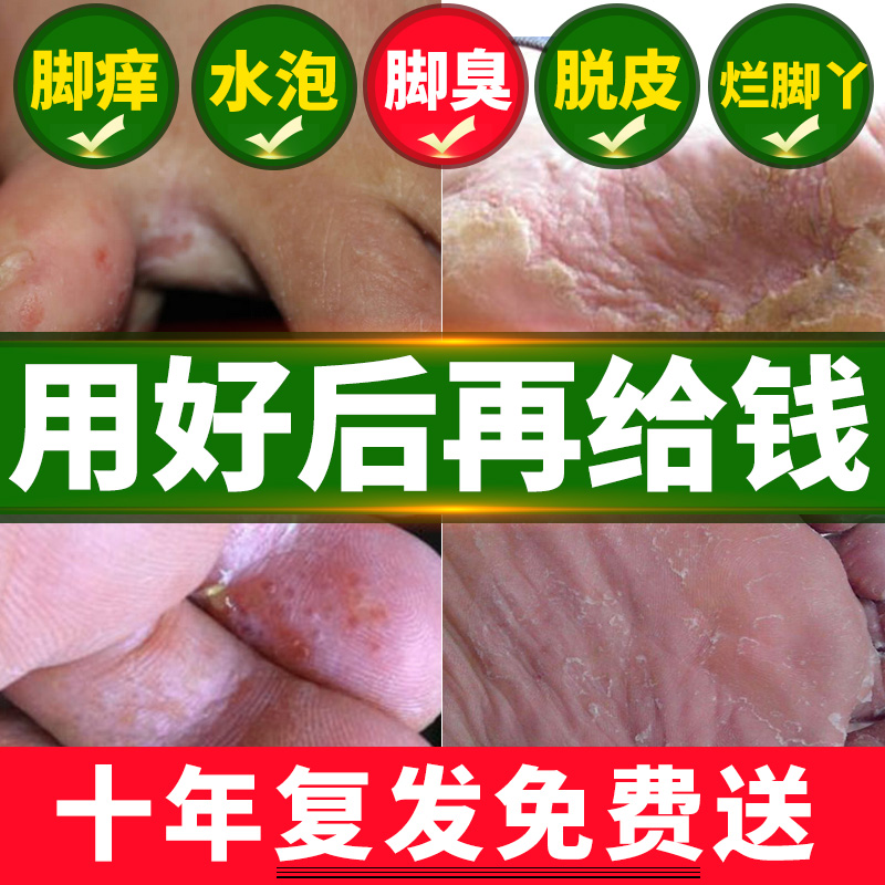 治腳氣膏去根神器真菌感染喷剂止痒脱皮泡脚药包粉杀菌除脚臭脚汗在类目 本地化生活服务, 健康服务, 足浴/洗浴/按摩中 - 来自Buy2taobao.com提供专业的淘宝代购服务