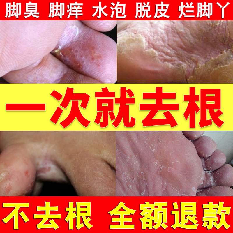 花安樂噴劑止癢脫皮泡腳藥包腳氣克星腳臭腳出汗去根殺菌神器正品在類目 本地化生活服務, 健康服務, 足浴/洗浴/按摩中 - 來自Buy2taobao.com提供專業的淘寶代購服務