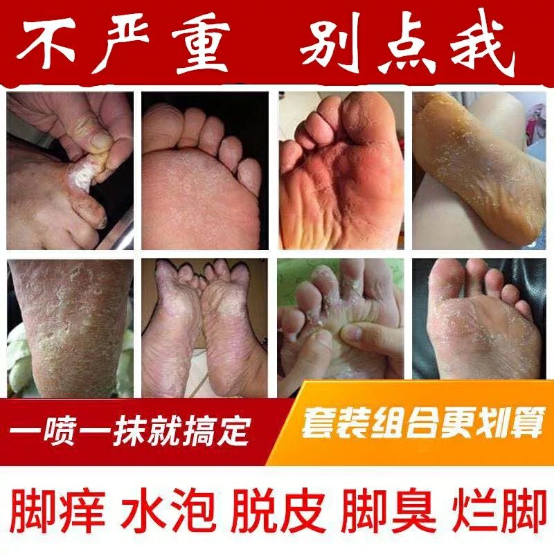 根治腳氣腳臭腳出汗偏方印度腳氣膏雲南本草腳氣噴劑日本小林救星在類目 本地化生活服務, 健康服務, 足浴/洗浴/按摩中 - 來自Buy2taobao.com提供專業的淘寶代購服務