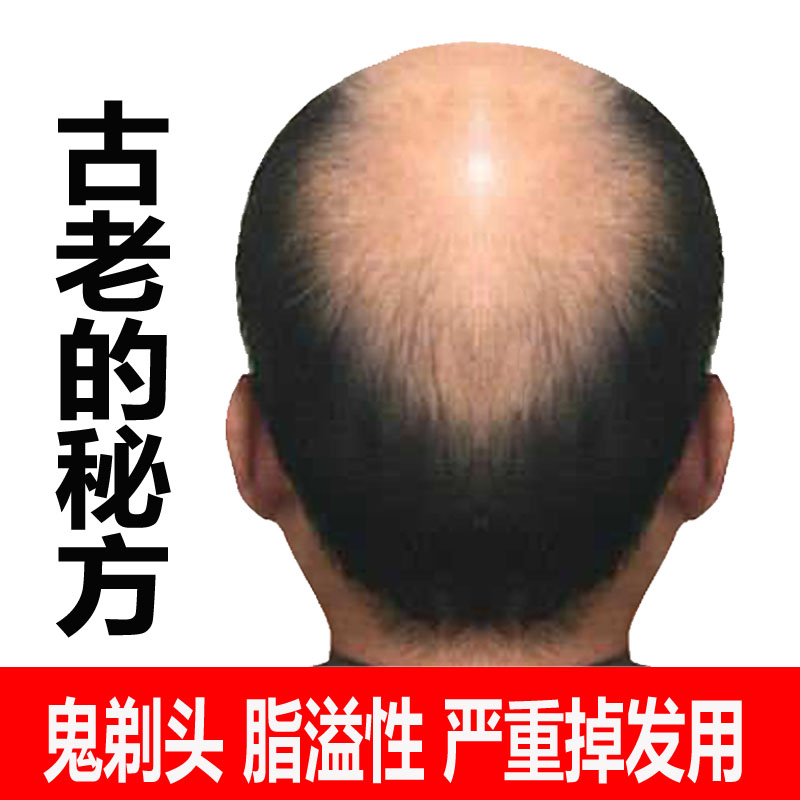Alopecia areata Germinal hair Hair Growth medium fast Seborrheic Alopecia Additional issue Men and womenin the Hair Care/Wig , Shampoo Conditioner (New) , Conditioner category - from Buy2taobao.com to provide professional Taobao agent buy service