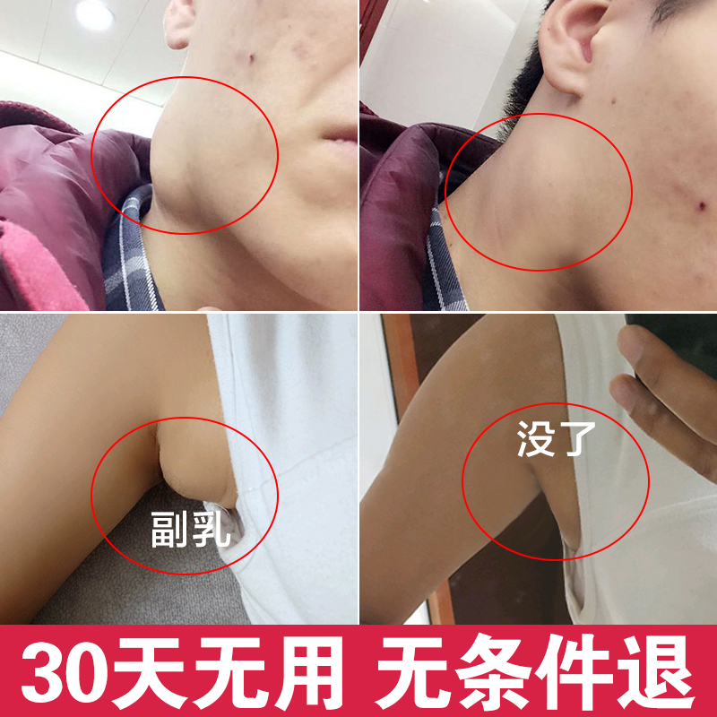 淋巴散结膏淋巴腫大炎消贴去淋巴结副乳消除神器腋下结节疏通颈部|ruв категории начало ежедневно, защитное оборудование, наколенники/талии/плечо/шея - от Buy2taobao.com для оказания профессиональной услуги покупки агента Taobao