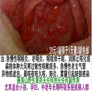 咽喉炎 支气管老慢性咽炎 异物感 干呕喉咙痒 咳