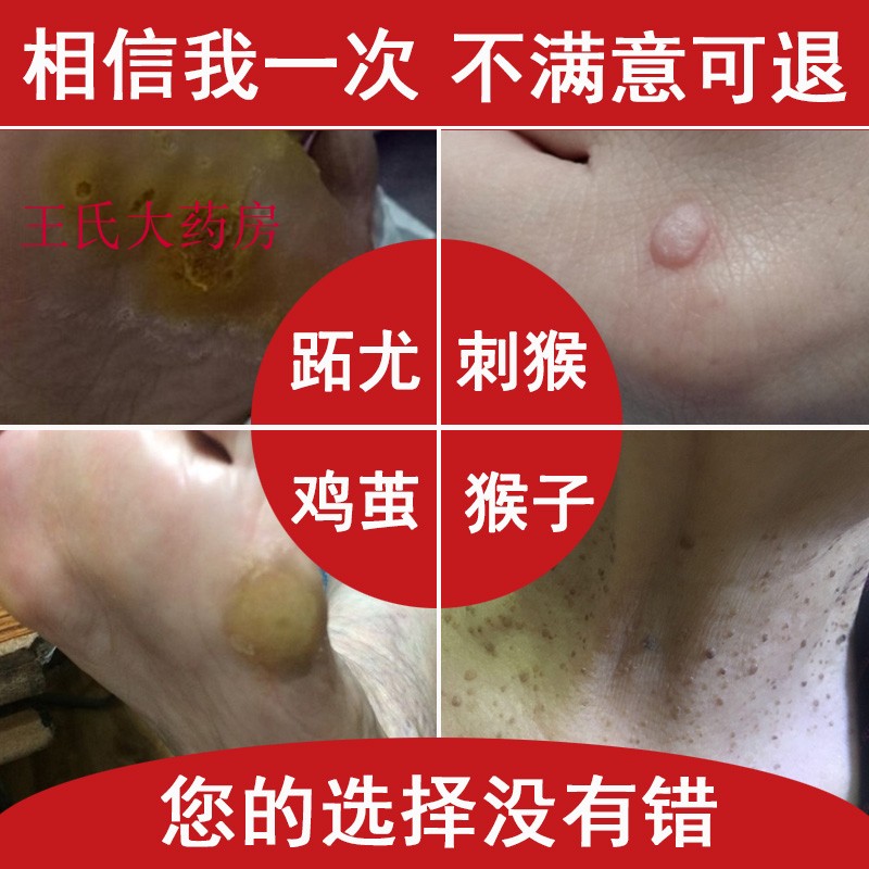 去刺猴手足部魚鱗痣膏去除猴子老繭絲狀尤脖子肉刺腋下肉粒跖尤在類目 洗護清潔劑/衛生巾/紙/香薰, 洗髮沐浴/個人清潔, 身體護理, 其它身體護理產品中 - 來自Buy2taobao.com提供專業的淘寶代購服務