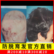 章光101瑞丝毛囊滋养液斑秃，增发密发护理强健发质成人男女头发稀