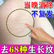 肥胖纹修复霜消除去肥胖纹，去除产后妊娠纹，大腿纹生长纹路淡化神器