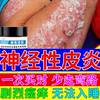 神经性皮炎外用膏顽固无激素皮肤病，真菌感染湿疹，止痒去顽固根bs