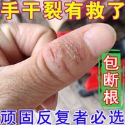 手干裂脱皮真菌感染手指开裂痒治成人儿童手足脚干裂去死皮修