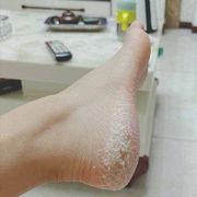 脚裂膏脚后跟干裂脱皮脚跟，皲裂膏脚裂口子，脚后跟干燥开裂真菌感染