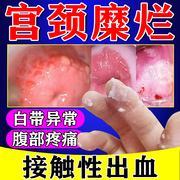 宫颈糜烂重度用专中药二度宫颈炎出血腹腰背坠痛妇科炎症抑菌凝胶