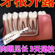 重度牙龈萎缩护龈固齿退缩牙齿敏F感正动松畸牙理出血护龈牙