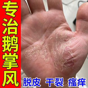 鹅掌风手癣膏真菌感染手足藓干裂脱皮瘙痒粗糙汗疱疹止痒专用药膏