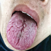 舌头裂痕地图舌裂纹舌齿痕灼口综合症舌头发白发厚麻木起泡抑菌液