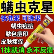 螨虫药膏止痒特效药人用脸上螨虫，除螨祛痘后背，杀菌淡化痘印专用药