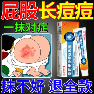 屁股湿疹慢性股藓久坐长痘红疙瘩大腿内侧痒真菌感染瘙痒专用膏药