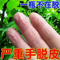 治疗手，脱皮的药膏真菌，感染手指头