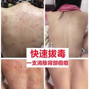 后背祛痘去背上痘痘背部痘痘印痘坑螨虫消印炎去除粉刺专用神器药