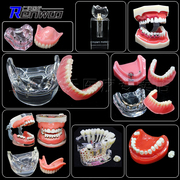 牙科模型牙模型，吸附性义齿种植杆卡口腔，牙模型全口假牙