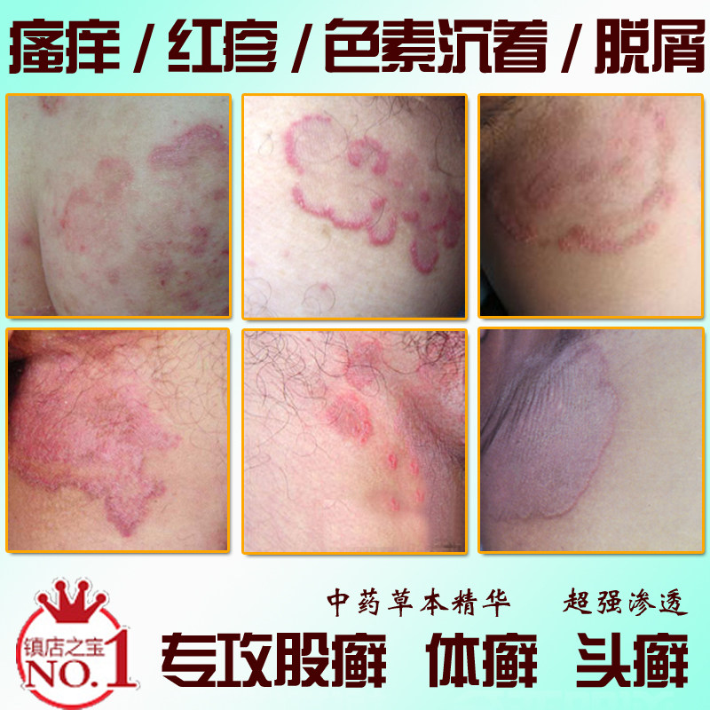 清雨坊<em>体股癣</em>专用去<em>体癣</em>阴囊廯湿疹瘙痒除铜钱