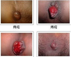<em>外痔疮</em>破了<em>怎么办</em>★<em>痔疮</em>如何调理<em>女生痔疮</em>