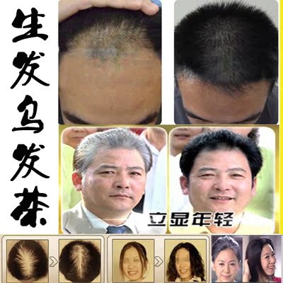 标题优化:生发乌发茶斑秃产后脱发脂溢性防脱止脱发育发白发生黑发何首乌粉