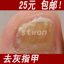 灰指甲特效药 灰指甲药 灰指甲专用特效药 灰指甲 亮甲灰指甲药水