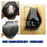 淘宝精品商城斑秃古方治疗<em>女性</em>男士斑秃顶脂溢