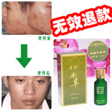 中药去痘印祛痘液 祛痘印祛痘疤痘坑去黑头化妆品产品热卖