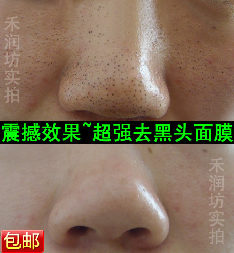 顽固黑头 毛孔粗大 深层排尽毛孔污垢 秘制黑头排出面膜 一疗程