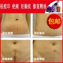 去疤痕凹凸疤痕修复精油祛痘印疤疤妊娠纹手术伤疤正品精油按摩