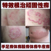 淘宝聚划算购物足癣足家堂脚气足癣脚癣脚痒水疱脚气脚气脚臭掉皮脚痒水疱型脚气包邮实体药房冲皇冠金肤康灵手足癣体癣牛皮癣花斑癣买5送1溢美甲康抗菌液 浓缩治疗灰指甲脚气手足癣皮炎水泡脱皮 特效中药促爽液+霜 鹅掌风 脚气特效药 手足癣 脱皮 水泡 烂脚丫根治脚癣