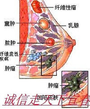 【<em>文胸</em>治<em>乳腺增生</em>】最新最全<em>文胸</em>治<em>乳腺增生</em> 