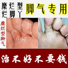 【治疗烂脚丫】最新最全治疗烂脚丫 产品参考