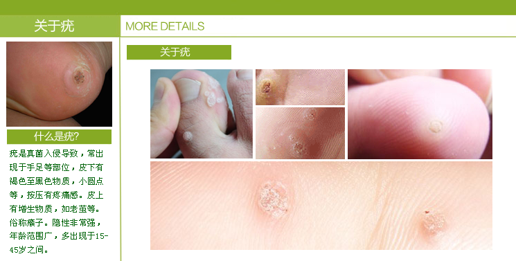 扁平疣 寻常疣 丝状疣 刺侯 跖疣五妙膏-脚气脚癣--,.
