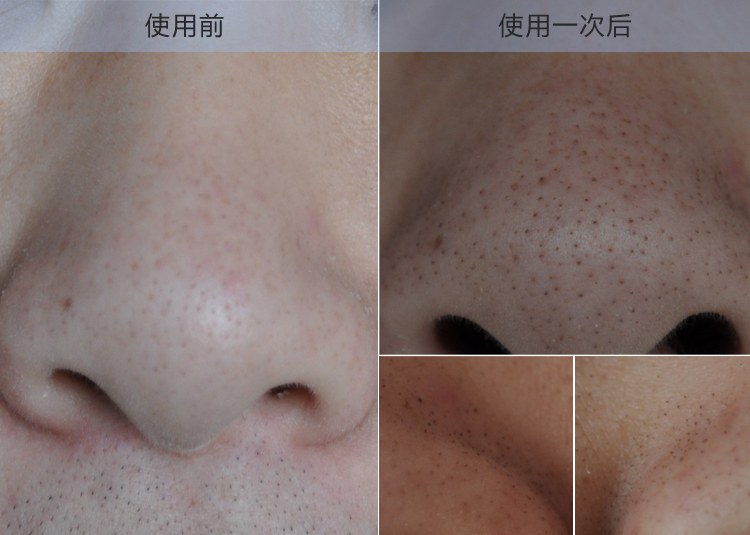 美绯 纯中药去黑头面膜粉 控油祛黑头导出 白头